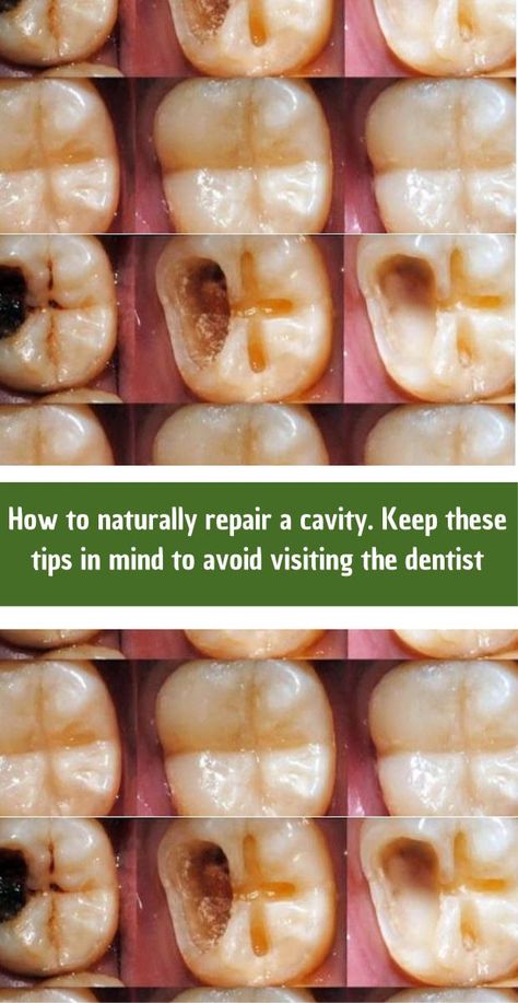 It’s important to clarify that while a healthy diet and good oral hygiene can help prevent cavities and may aid in the remineralization of teeth in very early stages, once a cavity has formed, it cannot be completely “repaired” naturally at home. Cavities are permanent damage to the tooth enamel that typically require dental intervention to treat. The information provided here aims to offer guidance on how to support oral health and potentially slow the progression of early tooth decay, but it should not replace professional dental advice and treatment. Mineral Rich Foods, Remineralize Teeth, Tooth Cavity, Tooth Decay Remedies, Heal Cavities, Teeth Whitening Remedies, Tooth Enamel, Teeth Health, How To Prevent Cavities