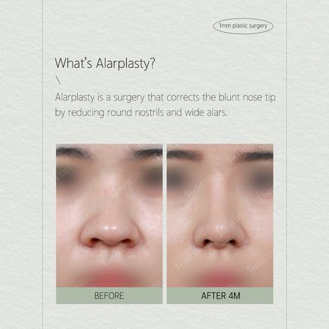 Blunt and Wide-looking Alar Base correction Small Alar Base Nose, Wide Nose Rhinoplasty, Change Appearance, Bulbous Nose, Rhinoplasty Before And After, Wide Nose, Beauty Procedures, Perfect Nose, Plastic Surgery Procedures