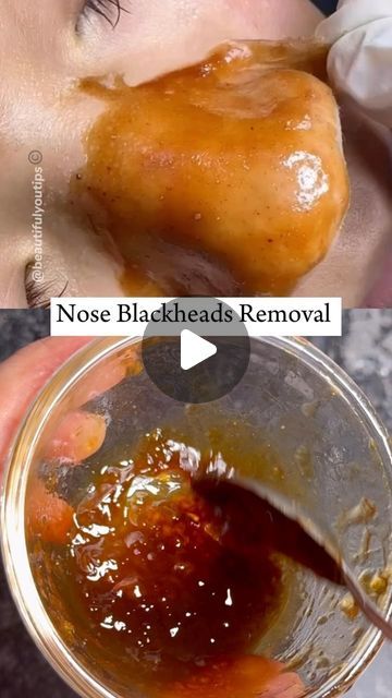 Best Mask For Blackheads, Diy Facemask Skincare Blackheads, Gelatin Mask For Blackheads, Diy White Head Remover, How To Remove Blackheads From Nose Diy, How To Remove Nose Pores, Blackheads Mask Diy, Black Head Remedies, Face Pack For Blackheads