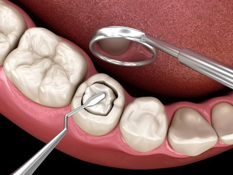 The term ‘plastic’ in periodontal plastic surgery has been derived from the Greek word, ‘plastic’. In Greek, it refers to modeling or sculpting. It is a sub-field of dentistry that specializes in correcting or restoring the function and form of teeth. Composite Fillings, Cavity Filling, Tooth Filling, Tooth Cavity, Dental Decay, Molar Tooth, Dental Fillings, Dental Cavities, Diy Teething