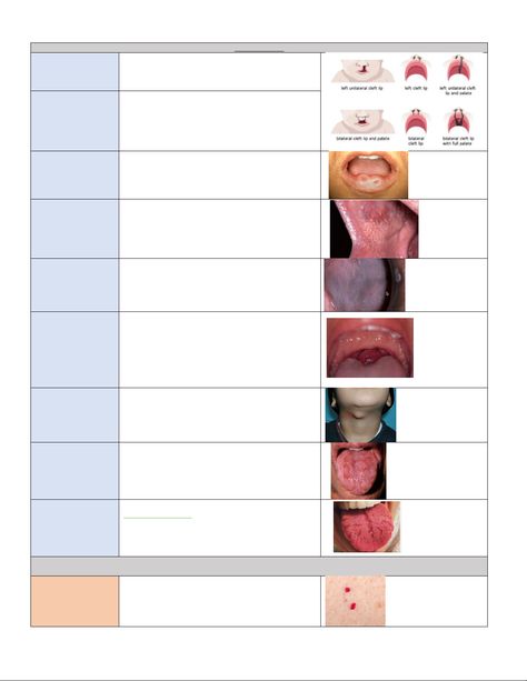 Mental-dental-pathology for INBDE 2022 19 pages - Oral Pathology Blitz DEVELOPMENTAL CONDITIONS - Studocu Langerhans Cell, Lichen Planus, Parotid Gland, Oral Pathology, Basement Membrane, Medical Words, Dental Videos, Basal Cell, Cleft Lip