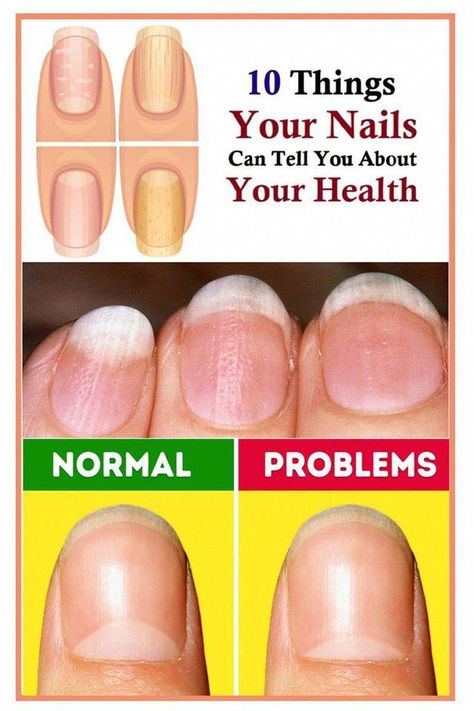 #RomanHairLossTreatment #WhatTongueSaysAboutHealth #NaturalRemediesForHairLoss #TongueHealthProblems #NailsHealth Natural Hair Growth Remedies, Tongue Health, Castor Oil For Hair, Brown Spots On Face, Striped Nails, Natural Shampoo, Nail Health, Body Hair, Toe Nails