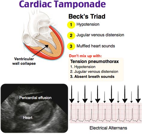 Cardiac Tamponade, Cardiovascular Nursing, Emt Study, Cardiac Sonography, Cardiology Nursing, Paramedic School, Nursing School Essential, Nursing Mnemonics, Cardiac Nursing