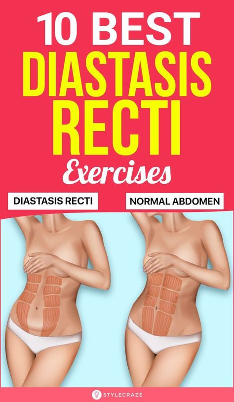 Diastis Recti, Exercises For Diastasis Recti, After C Section Workout, C Section Workout, Stomach Exercises, Diastasis Recti Exercises, Post Pregnancy Workout, Whole Body Workouts, Fitness Plans