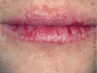 chapped lips Dry Lips Remedy, Chapped Lips Remedy, Sore Lips, Dehydrated Lips, Cracked Lips, Peeling Skin, Chapped Lips, Beauty Recipe, Dry Lips