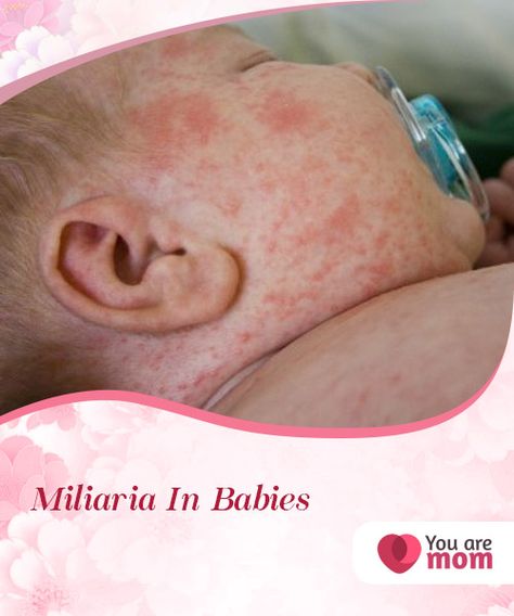 Miliaria In Babies   Miliaria in babies, also known as sudamina, is more common than you can #imagine. It is a skin rash that occurs in babies due to their #delicate #skin.  #Health Heat Rash Remedy For Babies, Heat Rash On Face, Skin Rash On Face, Face Rash Remedies, Newborn Rash, Baby Rash On Face, Baby Heat Rash, Heat Rash Remedy, Home Remedies For Rashes