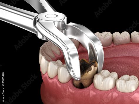 Dental Extraction, Dental Bonding, Bone Grafting, Molar Tooth, Dental Surgeon, Oral Surgeon, Tooth Removal, Tooth Extraction, Family Dental