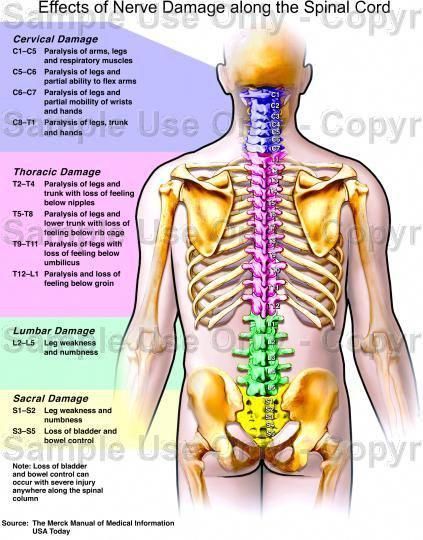 Effects of Nerve Damage Along the Spinal Chord ~ Infographic Nerve Anatomy, Spinal Nerve, Human Body Anatomy, Spine Health, Sciatic Nerve Pain, Human Anatomy And Physiology, Medical Anatomy, Nerve Damage, Medical Knowledge