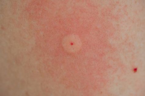 Identify the 10 Most Common Bug Bites in North America and How to Avoid Them | The Hearty Soul Bed Bug Bites Pictures, Spider Bites Pictures, Itchy Bug Bites, Ant Bites, Wasp Stings, Bed Bug Bites, Spider Bites, Bee Sting, Mosquito Bite