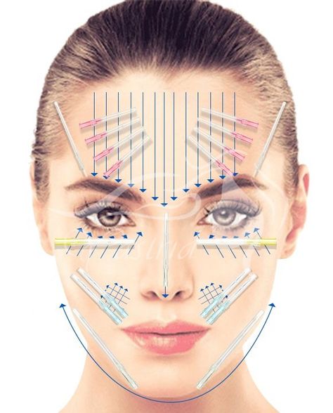 A Comprehensive Guide to PDO Thread Lift - Yastrid Medical Aesthetic Supplier Pdo Threading, Thread Lift Face, Pdo Thread Lift, Facial Injections, Pdo Threads, Skin Anatomy, Face Lift Surgery, Botox Alternative, Homemade Face Mask