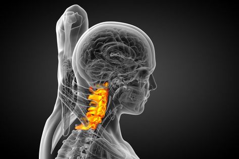 Exercises for Cervical Spondylosis With Foraminal Stenosis Cervical Spine Exercises, Foraminal Stenosis, Stenosis Exercises, Neck Pain Exercises, Nervus Vagus, Cervical Disc, Neck And Shoulder Exercises, Cervical Spondylosis, Neck Problems