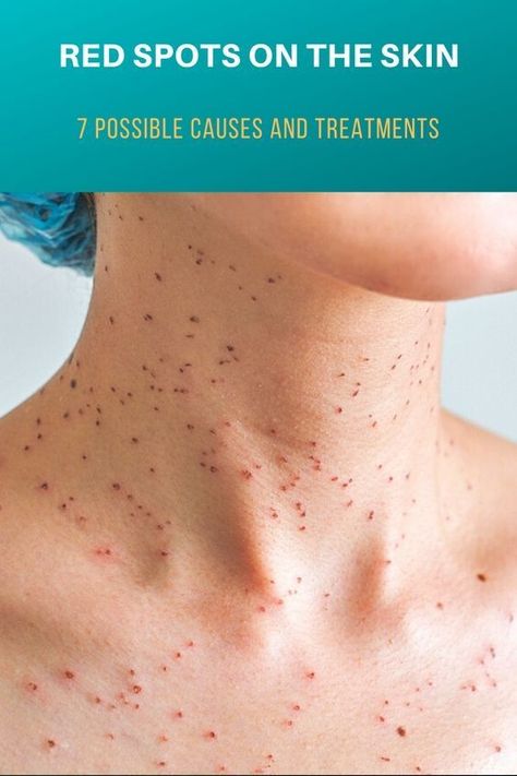 What do these red dots on your skin mean? Red Dots On Skin, Red Spots On Skin, Red Spots On Face, Red Skin Spots, Cherry Angioma, Sagging Cheeks, What Is Health, Healthy Living Inspiration, Healthy Living Motivation