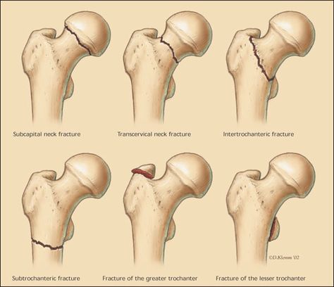 Fracture Types, Xray Anatomy, Orthopedic Nursing, Hip Fracture, Surgical Technologist, Anatomy Physiology, Nursing School Notes, Human Anatomy And Physiology, Orthopedic Surgery