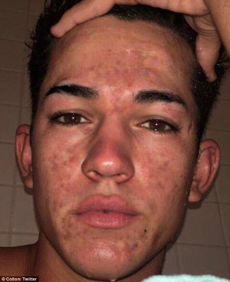 Acne: A 19-year-old boy (pictured in September 2017) from Los Angeles who suffered from cystic acne cleared his skin in just five months using a simple five-step natural routine Bad Skin Pictures, Guys With Acne, Acne Positive, Acne Positivity, Acne Men, Pimples On Forehead, Back Acne Remedies, Face Acne Treatment, Bad Skin