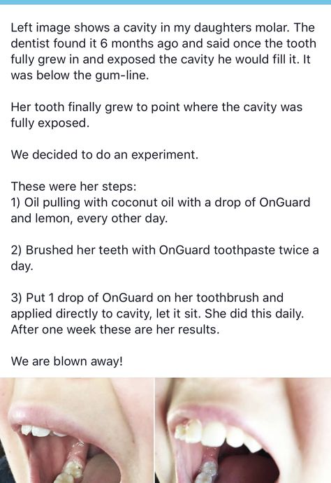 Teeth Oil Pulling, Repair Teeth Naturally, Homemade Oil Pulling, Teeth Grinding Remedy Essential Oils, How To Get Rid Of Plaque On Teeth, Skin Tags Removal Overnight Toothpaste, Oil Pulling For Cavities, Oil Pulling Before And After, Natural Cavity Remedy