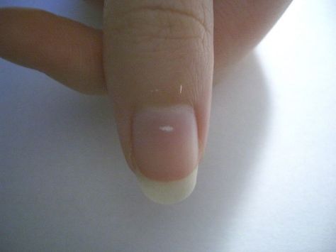 White Spots On Nails, Nail Disorders, White Things, Nail Health, Healthy Nails, White Mark, Holiday Nails, White Nails, Simple Nails