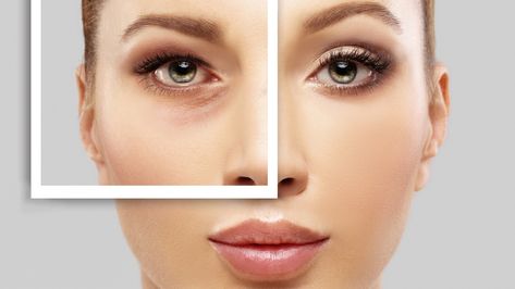 The Trendy Micro-Procedure That's Aiming For Your Eyelids Breast Implant Illness, Droopy Eyelids, Fat Transfer, Extra Skin, Facial Plastic Surgery, Excess Skin, Upper Eyelid, Facial Plastic, Breast Surgery