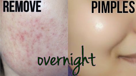 Remove Pimples Overnight, To Remove Pimples, C Beauty, Remove Pimples, Acne Overnight, Pimples Overnight, Skin Care Routine For 20s, Natural Acne, Acne Scar