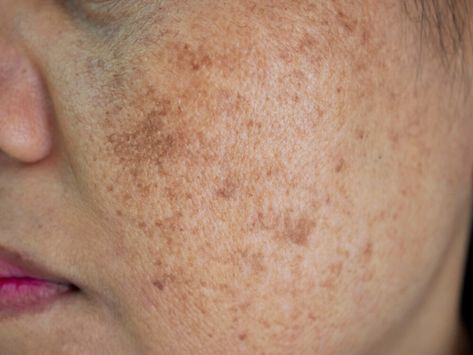 An even complexion is the wish of many women. We'll tell you seven effective home remedies for pigmentation. Spots On Face, Remove Dark Spots, Skin Clinic, Face Skin Care, Face Skin, Skin Treatments, Beauty Secrets, Womens Health, Dark Spots