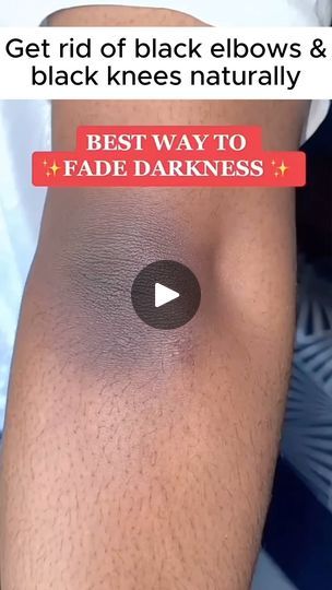 21K views · 5.7K reactions | Get rid of black elbows & black knees naturally 

Follow @jabeen_ki_jahaan for more ❤️

#skin#skincare#trending#selflove | Jabeen Ki Jahan | jabeen_ki_jahaan · Original audio How To Get Rid Of Black Knees, Black Elbows Get Rid Of, Blue Wallpaper Iphone, Skin Skincare, Black Knees, Blue Wallpaper, Wallpaper Iphone, Self Love, Skin Care