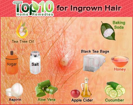 Home Remedies for Ingrown Hair Infected Ingrown Hair, Ingrown Hair Remedies, Top 10 Home Remedies, Underarm Hair Removal, Razor Bumps, Home Remedies For Hair, Diy Remedies, Beauty Remedies, Hair Remedies