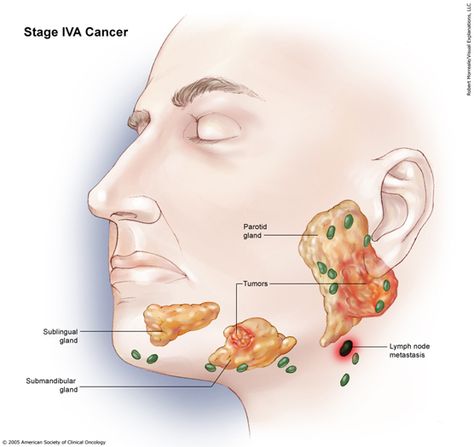 Parotid Gland Swelling, Salivary Gland Infection, Swimmers Ear Remedy, Swelling Remedies, Parotid Gland, Goo Hara, Salivary Gland, Facial Nerve, Lymph Nodes