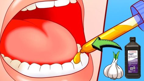 5 Ways To Relieve A Toothache In 1 Minute Infected Toothache Remedies, Essential Oils For Abscess Tooth, Tooth Ache Relief Remedies Diy, Inflamed Gums Remedies, Toothache Remedies Instant, Tooth Pain Remedies, Abscess Tooth, Severe Tooth Pain, Tooth Pain Relief