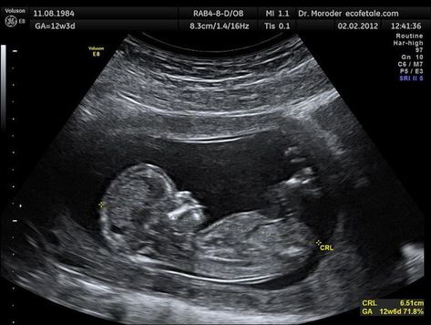 44-Year-Old ‘Stone Baby’ Found In Elderly Brazilian Woman’s Stomach, X-Rays Reveal ‘Face, Ribs And Spine’ Of Fetus Pregnancy Ultrasound, Baby Ultrasound, Ultrasound Tech, Ultrasound Pictures, Mang Thai, Unborn Baby, Baby Boy Photos, Baby Memories, Pregnancy Reveals