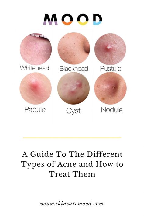 Acne Awareness, Nodule Acne, Cystic Acne Remedies, Different Types Of Acne, Pimples Under The Skin, Forehead Acne, Natural Acne Remedies, Types Of Acne, Acne Causes