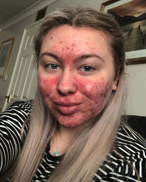 Abigail now feels confident enough to leave the house without any makeup on Girl With Acne, Back Acne Remedies, Acne Makeup, Acne Overnight, Bad Acne, Pele Natural, Flaking Skin, Natural Acne Remedies, Natural Acne