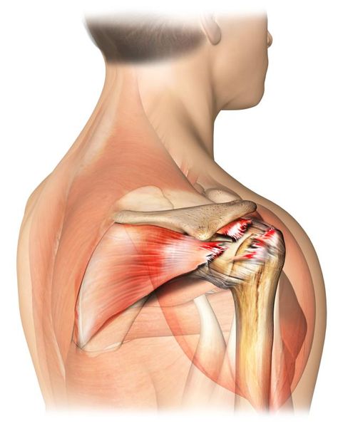 The 4 Signs of a Torn Rotator Cuff: A rotator cuff tear is an injury to the tendons of the shoulder joint. Torn Rotator Cuff Symptoms, Torn Rotator Cuff, Bursitis Shoulder, Rotator Cuff Muscles And Tendons, Rotator Cuff Pain, Rotator Cuff Surgery, Rotator Cuff Exercises, Shoulder Pain Exercises, Shoulder Rehab