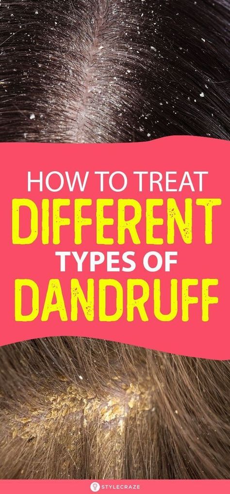 HOW TO TREAT DIFFERENT TYPES OF DANDRUFF AT HOME Bad Dandruff, Severe Dandruff, Dandruff Causes, Dandruff Solutions, How To Treat Dandruff, Home Remedies For Dandruff, Back Acne Remedies, Dandruff Flakes, Dry Scalp Treatment