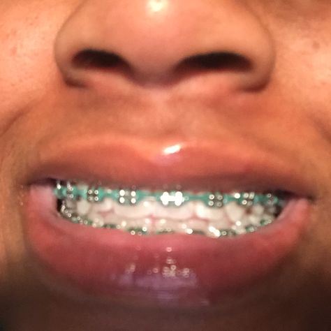 Follow: T I N Y Y 🔥🍭for more Power Chain Braces, Dental Braces Colors, Braces Colors Combinations, Braces Ideas, Green Braces, Cute Braces Colors, Pretty Teeth, Braces Tips