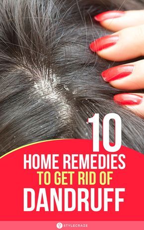 Bad Dandruff, Natural Dandruff Remedy, Hair Mask For Dandruff, Dandruff Causes, Home Remedies For Dandruff, Rid Of Dandruff, Dry Scalp Treatment, Dandruff Remedy, Getting Rid Of Dandruff