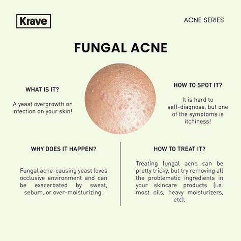 Fungal acne Fungal Acne Vs Bacterial Acne, Skin Knowledge, Face Acne Treatment, Blind Pimple, Fungal Acne, Pimples Under The Skin, Acne Soap, Acne Toner, Skin Facts