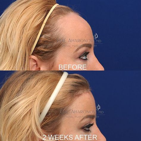 Forehead Reduction Surgery, Forehead Reduction, Face Surgery, Plastic Surgery Gone Wrong, Reduction Surgery, Facial Fillers, Facial Contouring, Celebrity Plastic Surgery, Nose Job