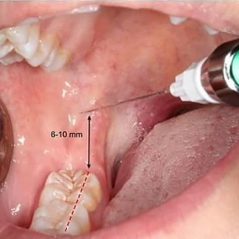 DENTISTRY MY WORLD® on Instagram: “Inferior Alveolar nerve block technique. Tag your friends 👇 Follow @dentistrymyworld for more ❤” Mandibular Nerve, Dental Charting, Dental Pictures, Local Anesthesia, Dental Assistant Study, Dental Hygiene Student, Dental Posters, Dental Aesthetics, Dental Videos