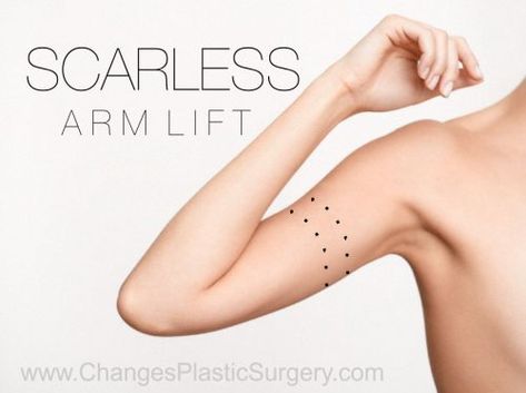 Scarless Arm Lift | The Future of Brachioplasty Arm Lift Surgery, Skin Removal Surgery, Skin Tightening Procedures, Loose Fat, Remedies For Skin, For Skin Tightening, Home Remedies For Skin, Arm Lift, Extra Skin