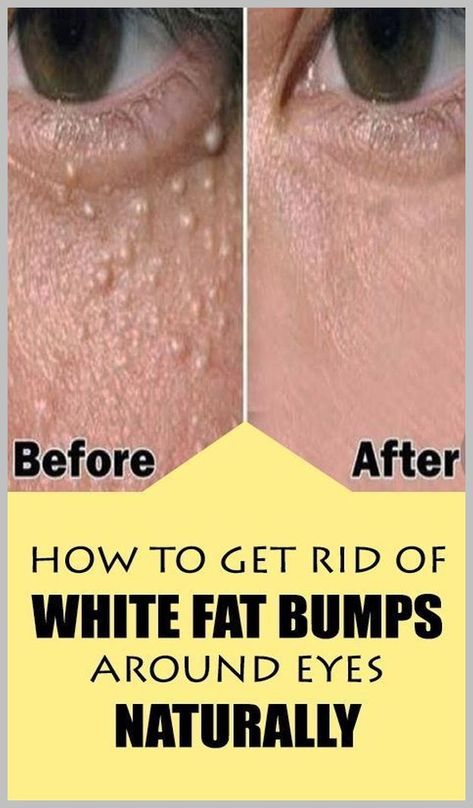 How to Get Rid of White Fat Bumps Around Eyes Naturally Lose 40 Pounds, Health Risks, Skin Care Treatments, How To Slim Down, Skin Problems, Bump, Natural Remedies, Skin Care Tips, Health Tips