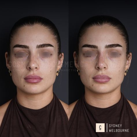 Our non-surgical rhinoplasty is a 15-minute injectable procedure that immediately improves the appearance of your nose. It’s a highly effective solution that can: - Hide bumps and humps - Lift and refine your nose tip - Slim and define your nose bridge - Balance the shape and size of your nose - Straighten a crooked nose - Improve poor surgical rhinoplasty results ⁠ Did you love this result? Want to know if it's right for you? Comment 'NOSE' to claim your complimentary opinion. ⁠⁠⁠ This con... Crooked Nose, Nose Tip, Nose Bridge, The Shape, Bridge, Love This