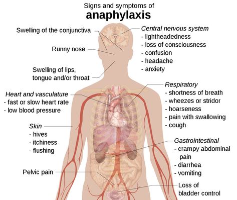 1467px-Signs_and_symptoms_of_anaphylaxis.svg How To Retain Information, Slow Heart Rate, Medical Things, Anaphylactic Shock, Gallery Poster, Medicine Notes, Allergy Awareness, Bladder Control, Nursing School Tips