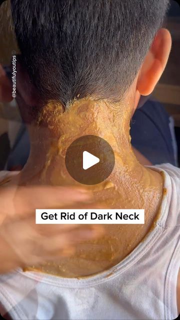 How To Get Rid Of Dark Neck, Dark Skin Around Neck, Dark Neck Remedies, Tan Removal Home Remedies, Get Rid Of Dark Neck, Skin Lightening Diy, Dark Neck, Tan Removal, Whitening Face