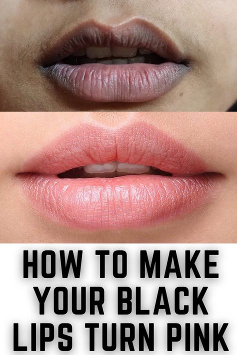 Darkness Around Mouth, Remedies For Dark Lips, Natural Pink Lips, Lip Lightening, Mouth Lips, Lips Black, Hyper Pigmentation, Dark Spots On Face, Dry Skin Remedies