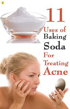 11 Effective Ways To Use Baking Soda For Treating Acne : The excess oil is responsible for breakout of pimples and blackheads. The greatest benefit of this home remedy is that it is absolutely easy to use and cheap. Baking Powder For Cleaning, Uses Of Baking Soda, Baking Soda For Acne, Brown Spots On Hands, Brown Age Spots, Brown Spots On Skin, Treating Acne, Brown Spots Removal, Brown Spots On Face