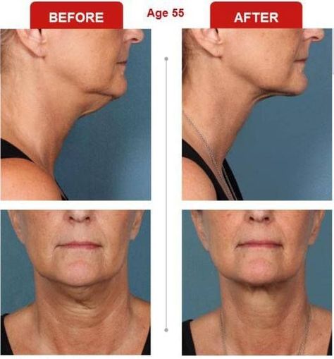 Kybella Before and After photos for Double Chin Coconut Oil Hair Growth, Botox Before And After, Body Ideas, Aesthetic Center, Before And After Pics, Facial Fillers, Coconut Oil Hair Mask, Botox Fillers, Coconut Oil Hair