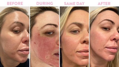 Prp Microneedling Before And After, Prp Face Before And After, Micronidelling Face, Micro Needling Before And After, Microneedling Before And After, Prp For Face, Skinpen Microneedling, Prp Microneedling, Prp Facial