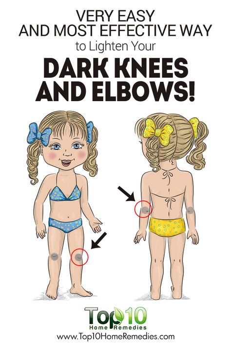 Very Easy And Most Effective Way to Lighten Your Dark Knees and Elbows! Dark Knees And Elbows, Dark Knees, Dark Elbows, Top 10 Home Remedies, Dark Underarms, Skin Remedies, Sagging Skin, Skin Tips, Lifestyle Changes