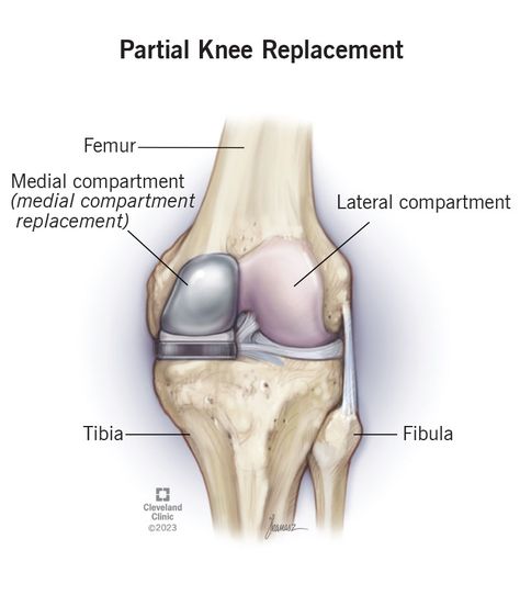 How Long Does It Take To Recover From a Partial Knee Replacement? Partial Knee Replacement Recovery, Knee Replacement Recovery, Parts Of The Knee, Partial Knee Replacement, Anterior Cruciate Ligament, Improve Mobility, Cruciate Ligament, Knee Replacement Surgery, Knee Replacement