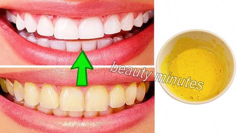 Teeth Yellow, Best Teeth Whitening Products, At Home Teeth Whitening, Teeth Whitening At Home, Home Teeth Whitening, Teeth Bleaching, Whitening Products, Yellow Teeth, Best Teeth Whitening