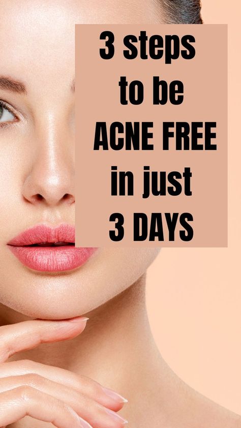 steps to be acne free in just 3 days How To Get Clear Acne Free Skin, Best Facial For Acne, Clean Face Tips Clear Skin, Homemade Remedies For Acne, How To Clear Acne In A Week, How To Keep Your Face Acne Free, How To Get Rid Of Acne In A Day, How To Clean Acne, How To Get Ride Of Acne In A Day